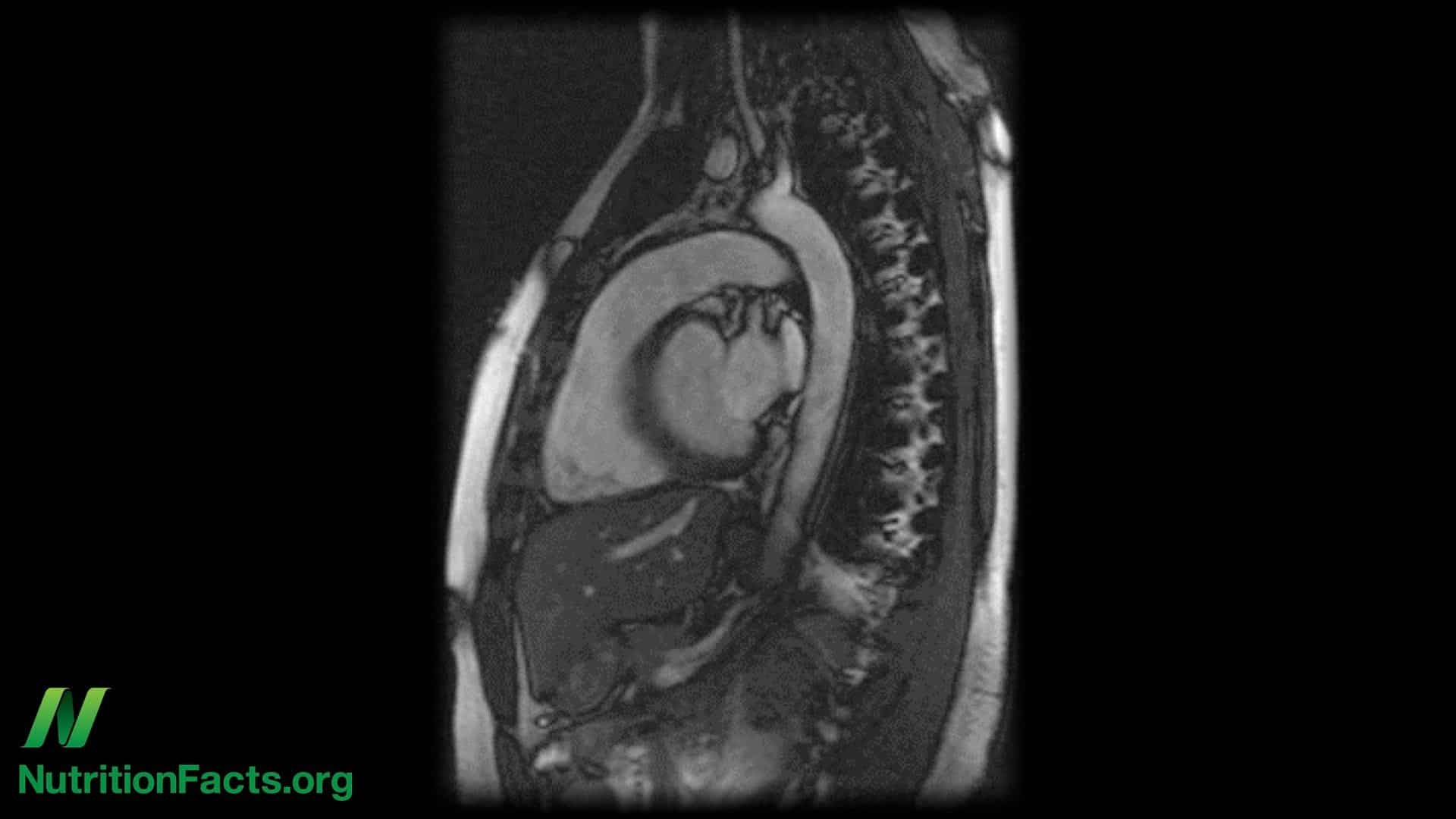 Abdominal aortic aneurysms- ticking time balloons