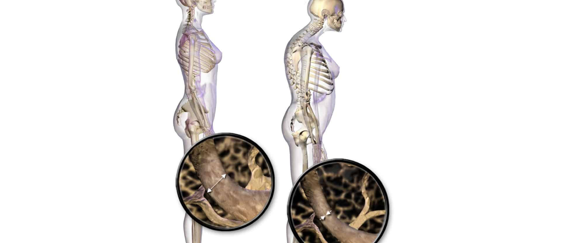 Alkaline Diets, Animal Protein, and Calcium Loss