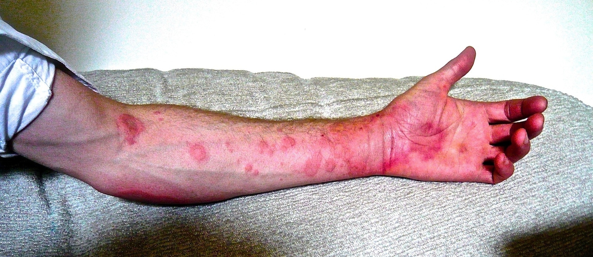 Tick Bites, Meat Allergies, and Chronic Urticaria